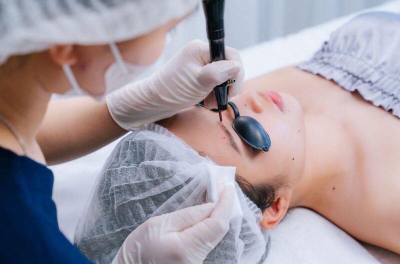 Plasma mụn ruồi là phương pháp làm đẹp nhẹ nhàng, không xâm lấn