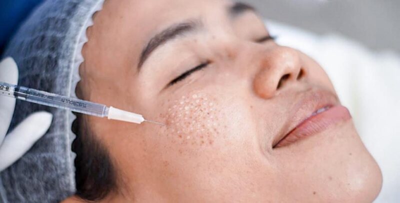 Tiêm meso trị nám là phương pháp làm đẹp được yêu thích