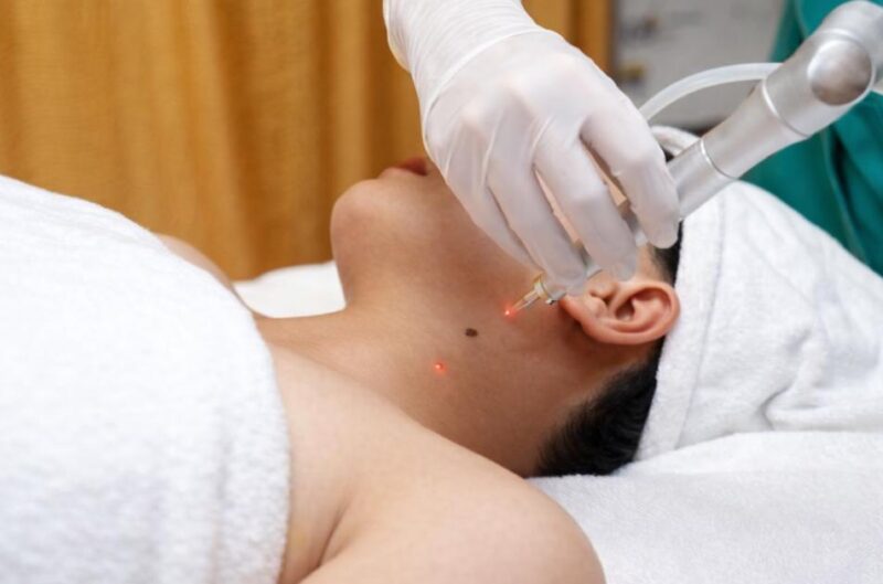 Plasma nốt ruồi giúp cải thiện vẻ đẹp làn da và mang lại sự tự tin hơn